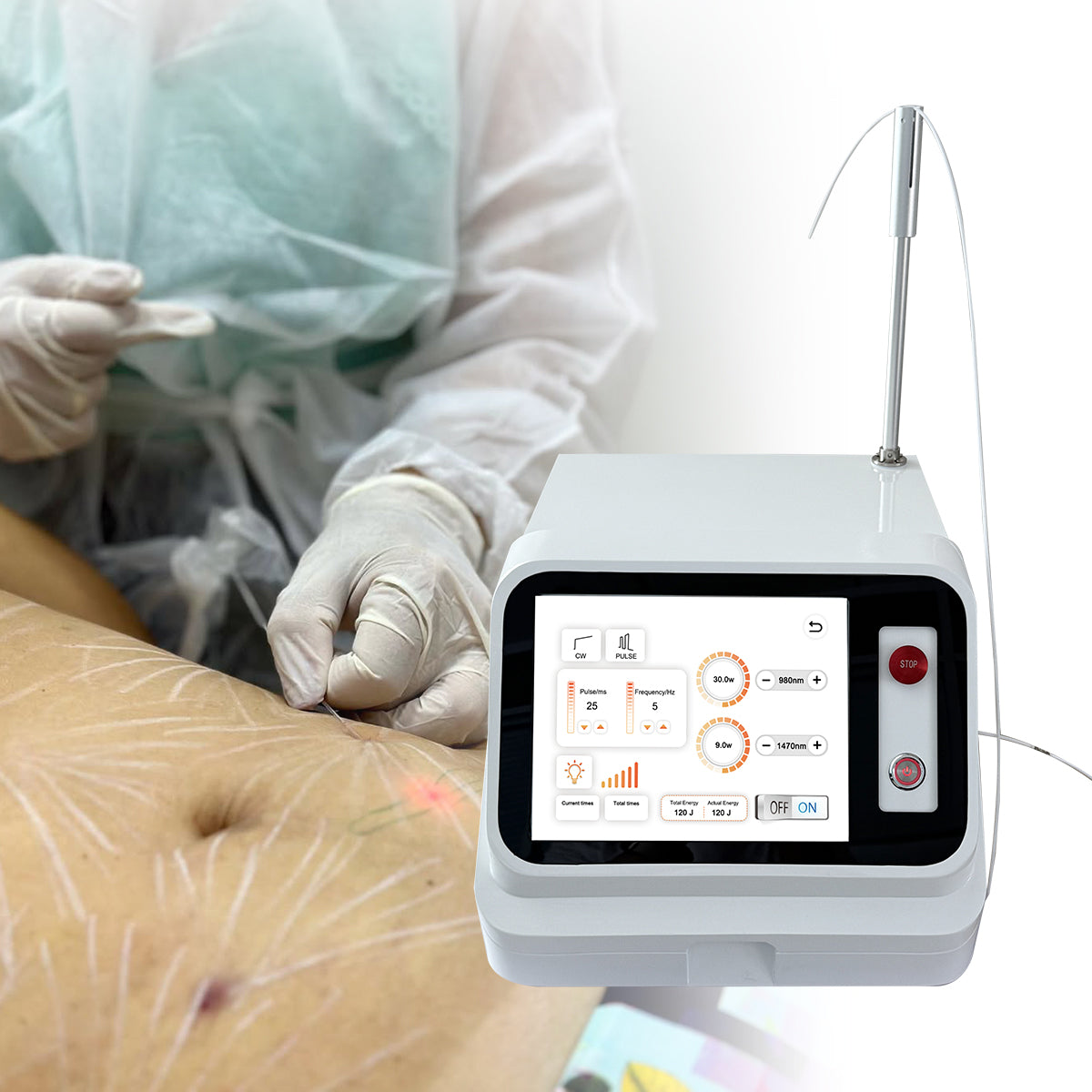 Endofibre Lipolysis System 1470nm / 980nm